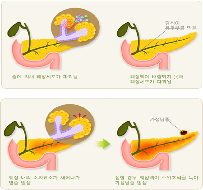 중등증-중증 아토피 피부염